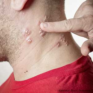 shingles-infection