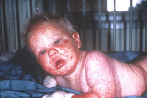 Generalized-vaccinico-John-M-Leedom